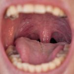 Epiglotun uzaması: nedenleri, belirtileri ve tedavi yöntemleri
